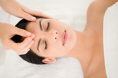 42397406 - woman in an acupuncture therapy at the health spa